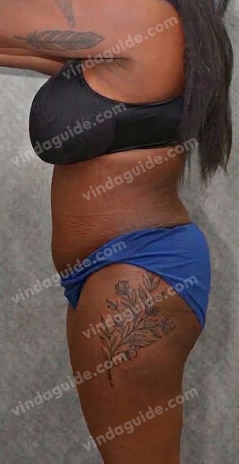 Rachael after, side view